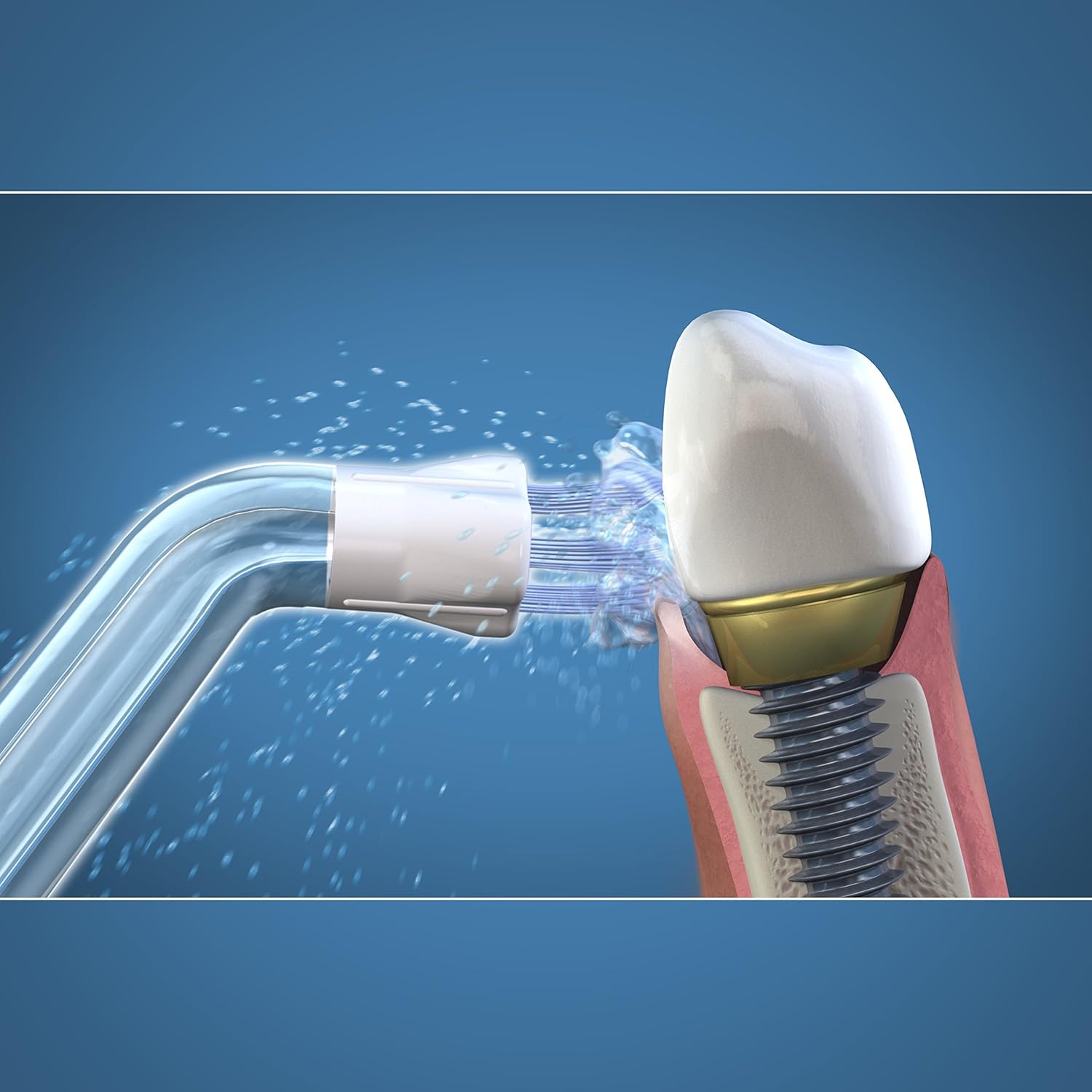 Waterpik Classic Boquilla de Agua a Presión de Repuesto para Irrigador Inalámbrico de Agua - Imagen 3